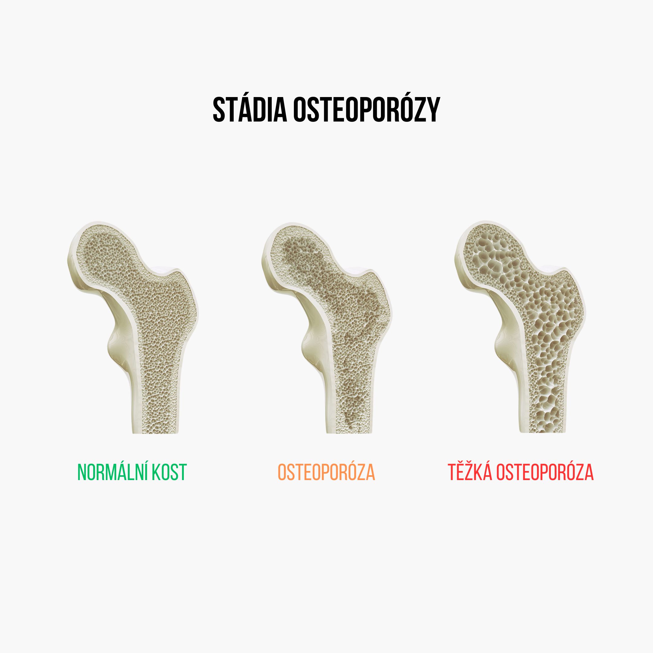 Osteoporoza